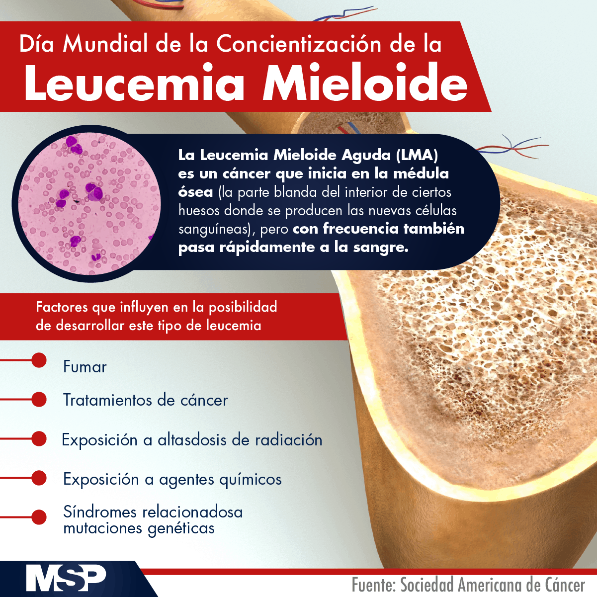 Día Mundial de la Concientización de la Leucemia Mieloide