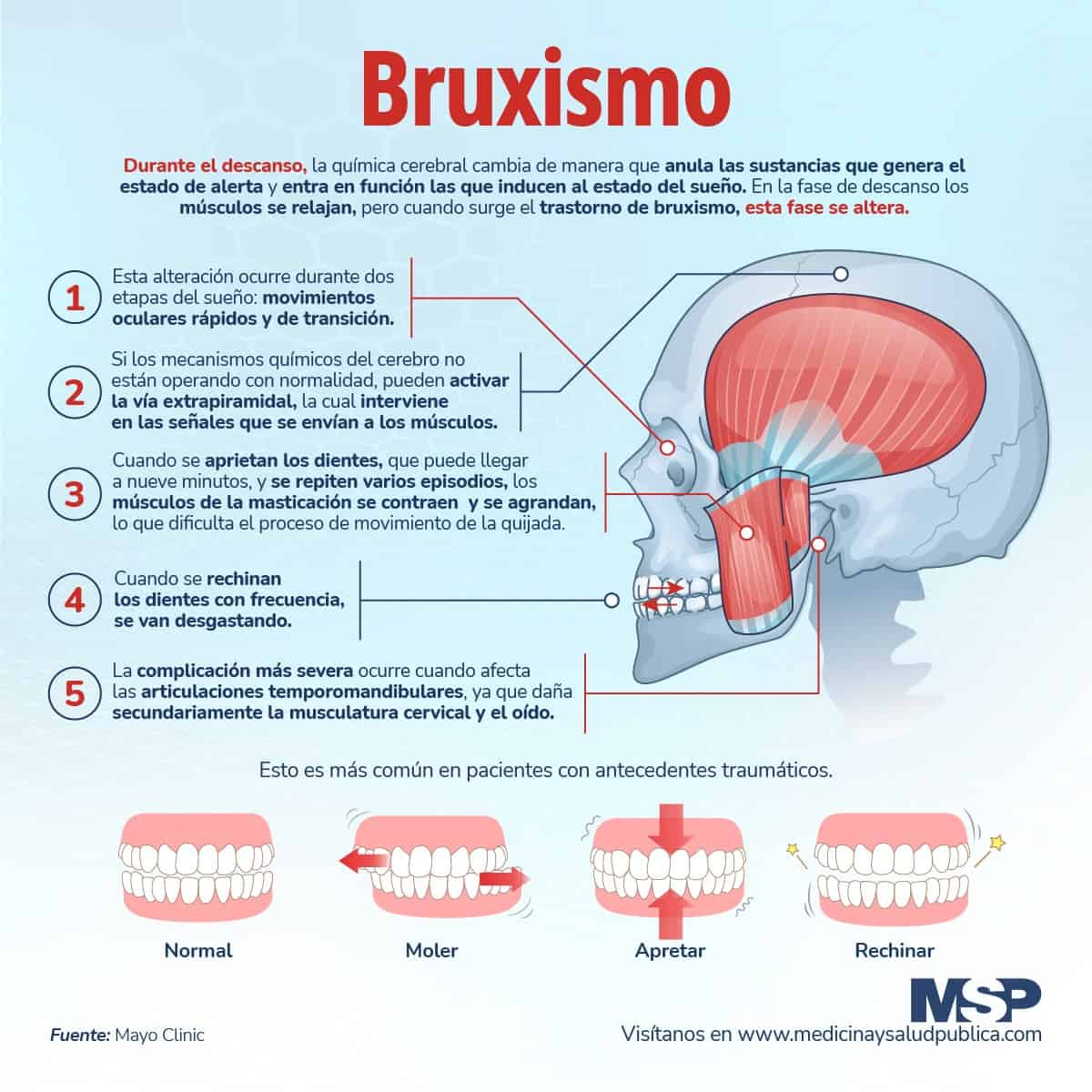 Bruxismo Infografía