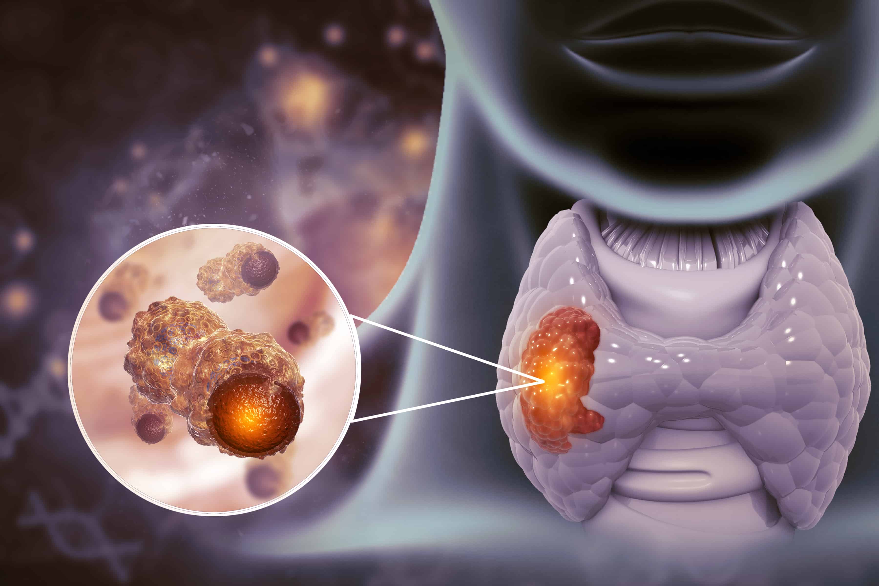 Ronquera o no puede tragar Conozca sobre el cáncer nasofaríngeo y