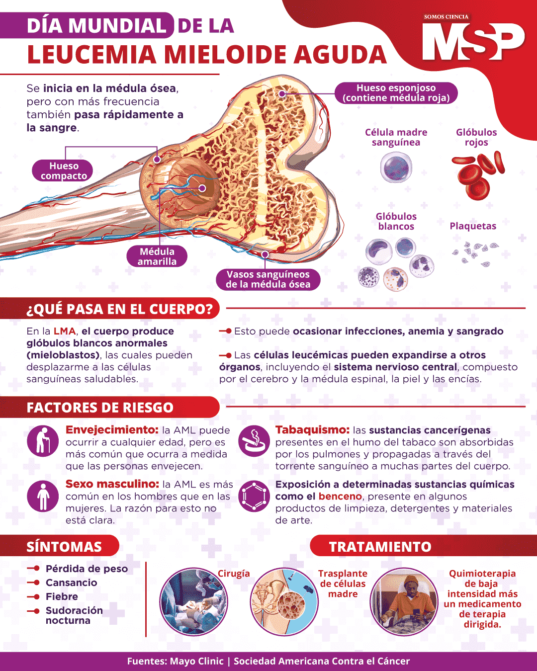 Leucemia Mieloide Aguda