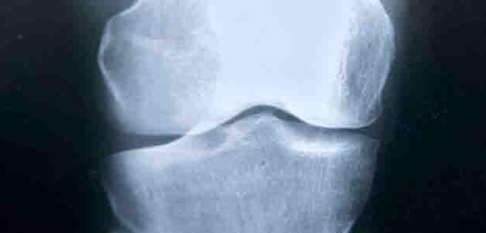 Una mutación predispone a la fractura de fémur en pacientes con osteoporosis