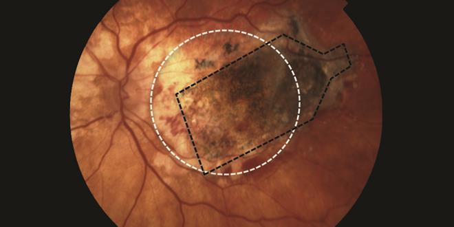Un implante de retina frena la ceguera causada por la degeneración macular