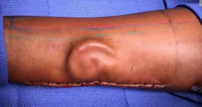Una soldado perdió su oreja en un accidente y los médicos le crearon otra en el antebrazo