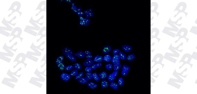 Una proteína mantiene dormidas las células metastásicas del cáncer de mama
