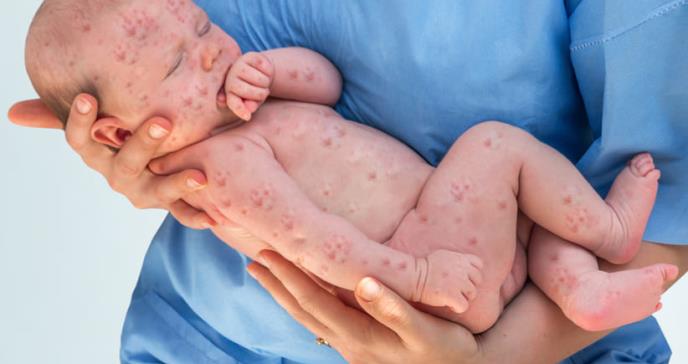 8 mitos sobre las vacunas que explican el brote de sarampión actual