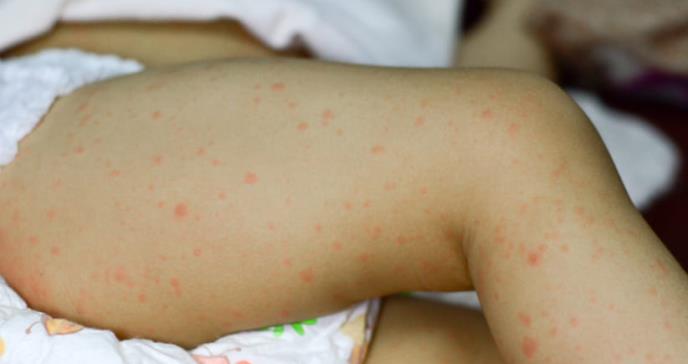 Alerta en América por el mayor brote de sarampión en una época