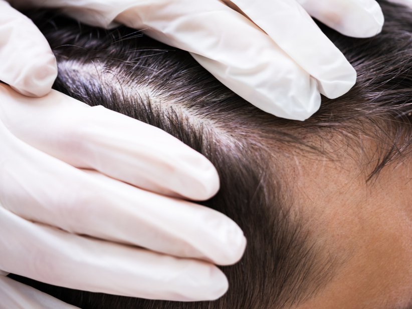 espejo agencia terrorismo Nuevos tratamientos tecnológicos pudieran mejorar la alopecia androgénica