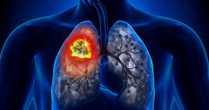 Importancia de mantener tratamiento para cáncer de pulmón durante pandemia de COVID-19