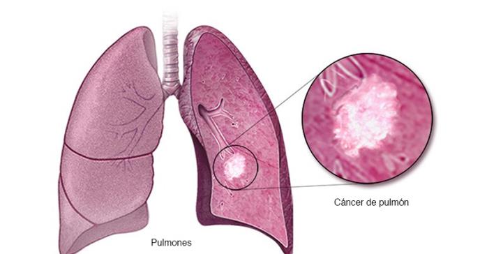 Cáncer de pulmón:  patología originada en gran proporción por malos hábitos conductuales