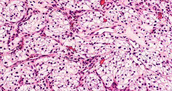 Carcinoma de células renales: cinco cosas que debe saber