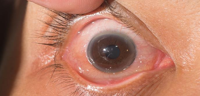 La ceguera causada por cataratas oculares es 100% prevenible