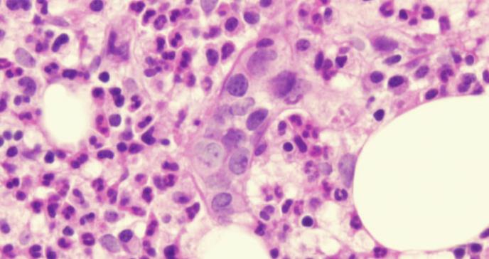 Nuevo subgrupo de células B pro-angiogénicas aumenta en cáncer e inflamación crónica