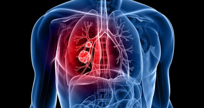 Científicos desarrollan un método para detectar ADN canceroso en la sangre de pacientes con cáncer de pulmón