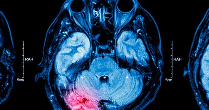Delirio después de una cirugía severa puede estar asociado con una lesión cerebral
