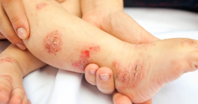 La superficie de la piel no lesional distingue la dermatitis atópica con alergia alimentaria como un endotipo único