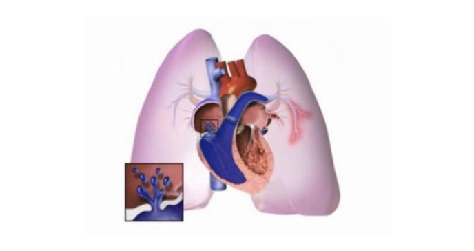 Descrita una región en el genoma implicada en el desarrollo de la hipertensión arterial pulmonar