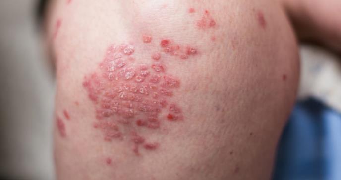 Descubren eczema único relacionado con las alergias alimentarias