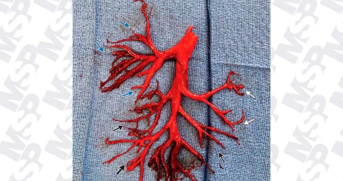 El inusual caso del hombre que tosió un coágulo de sangre intacto de su bronquio que dejó asombrados a los médicos