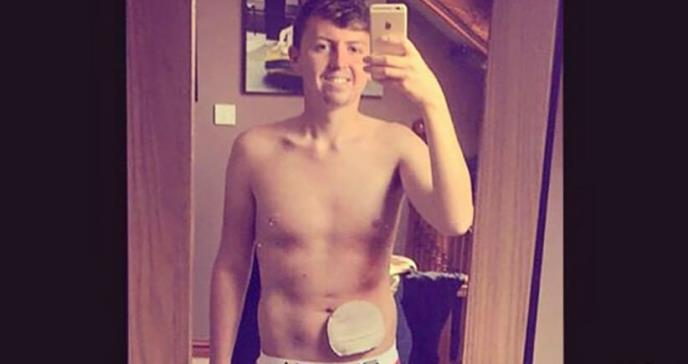 El joven que decidió mostrar su bolsa de colostomía y se volvió un fenómeno viral