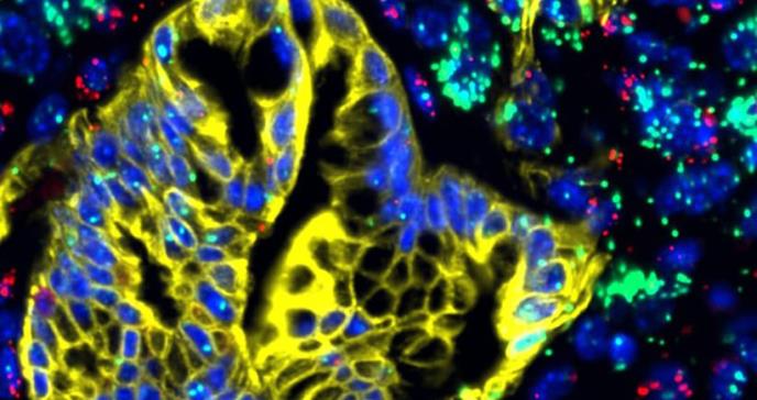 El talón de Aquiles del cáncer de páncreas que facilitará su dianóstico y tratamiento
