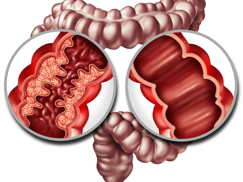 Comparación entre un colon normal y uno con enfermedad de Crohn