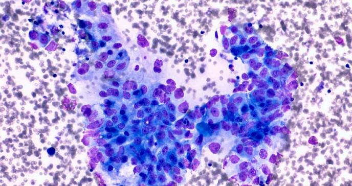 Ensayo clínico revela nuevos subtipos de cáncer de páncreas avanzado