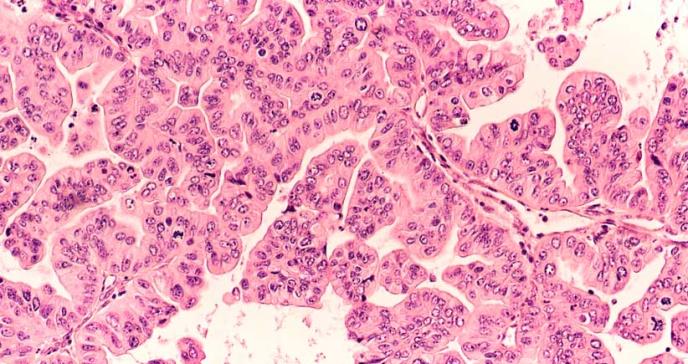 Estudio cuestiona el vínculo entre los polvos de talco y el cáncer de ovario