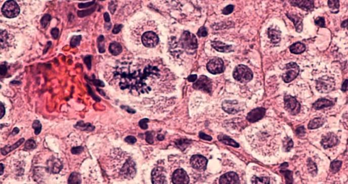 Estudio encuentra riesgos de cánceres de la sangre después de quimioterapia en tumores sólidos