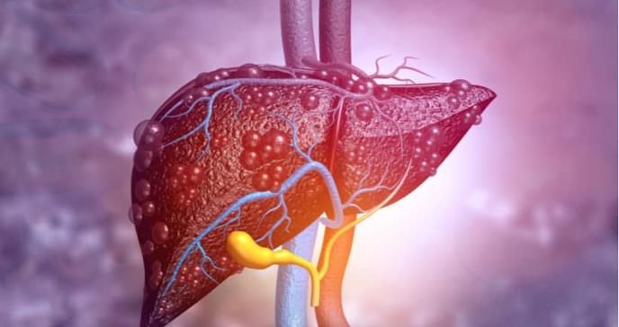 Estudio revela las causas del fallo del hígado en pacientes con hepatitis alcohólica aguda