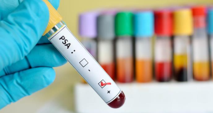 Cáncer de próstata podría ser detectado con nuevo análisis de sangre