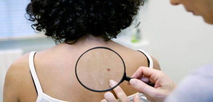Disponible en Cuba fármaco para el tratamiento del cáncer de piel