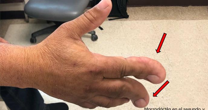 Salvan extremidad de paciente con raro tumor de la mano en Hospital Oncológico de Puerto Rico
