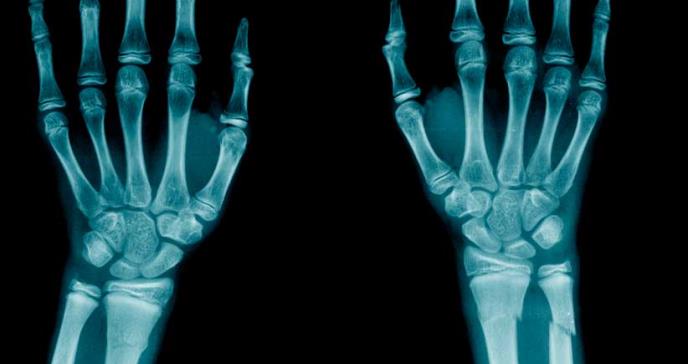Pacientes con dermatitis atópica tendrían mayor riesgo de fracturas