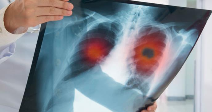 Tabaquismo aumentaría drásticamente la mortalidad por cáncer de pulmón