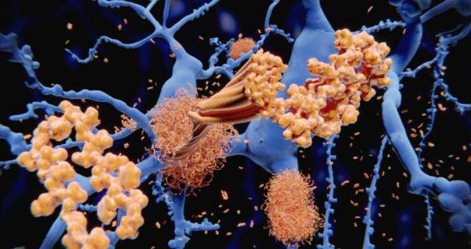 Hallan nueva proteína para retardar progreso del alzhéimer