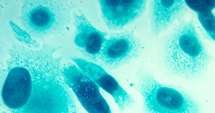 Hallan posible blanco terapéutico para combatir el cáncer de próstata