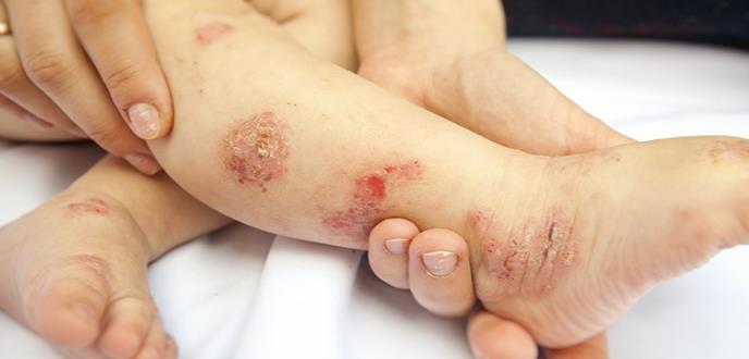 Como combatir la Dermatitis Atópica en niños y adultos