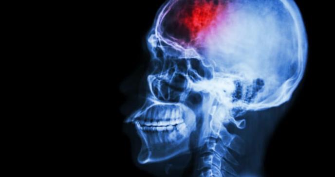 Ictus, seis síntomas que alertan de un accidente cerebrovascular