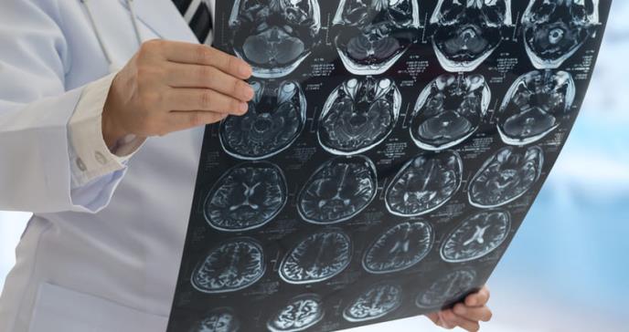 7 síntomas que le ayudarán a identificar derrames cerebrales