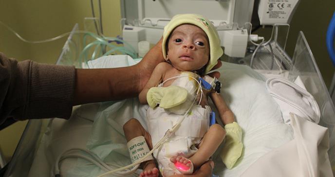 Realizan cirugía cardíaca a bebé prematuro de 1500 gramos por primera vez en República Dominicana