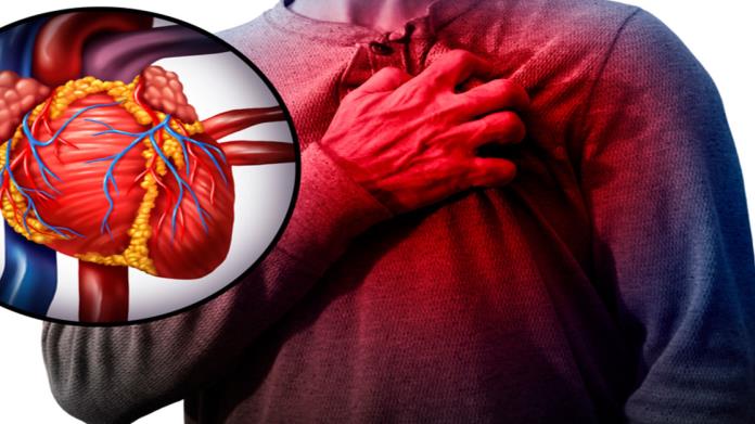 Infarto: condición altamente prevalente pero prevenible