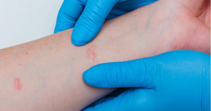 Iniciativa busca resolver desafíos de pacientes con dermatitis atópica