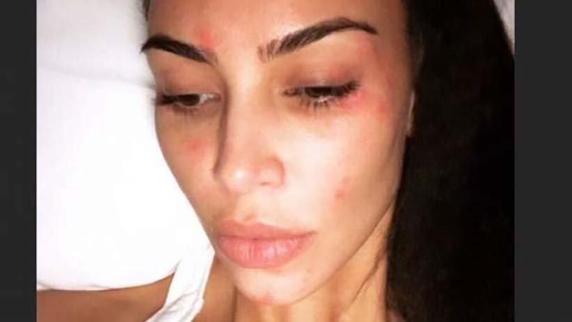 Kim Kardashian, sin miedo a mostrar su psoriasis a sus seguidores