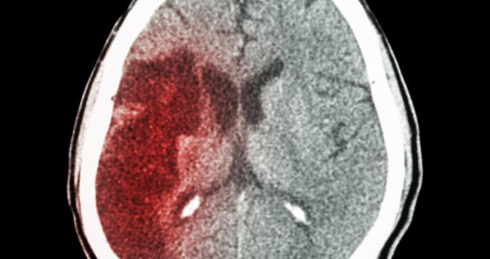 Neurólogos solicitan crear protocolos uniformes para declarar muerte cerebral