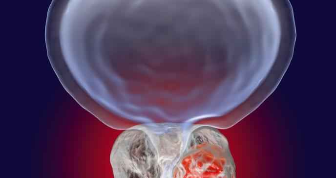 La última generación de antiandrógenos rescata a los pacientes con cáncer de próstata con metástasis