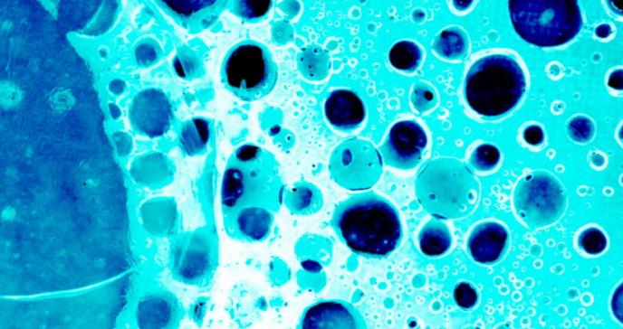 Las cuatro propiedades únicas de las células de la metástasis en cáncer