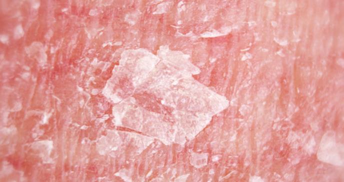 Las enfermedades de la piel constituyen la cuarta causa más frecuente de la enfermedad humana