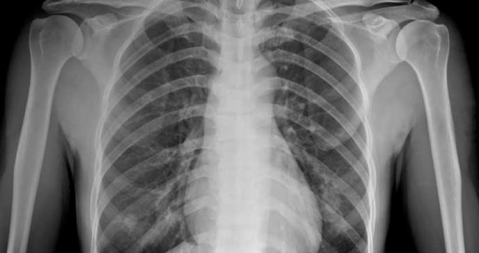 Las radiografías de tórax no detectan la cuarta parte de los cánceres de pulmón, según estudio