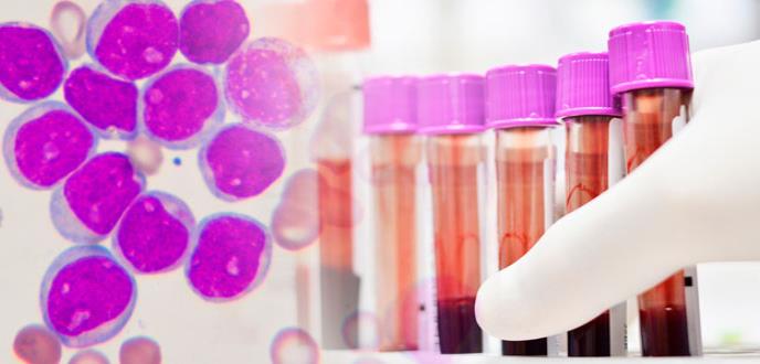 Un nuevo fármaco presenta resultados prometedores contra la leucemia mieloide aguda
