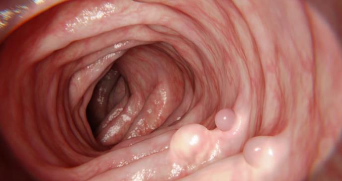 Lo que se debe saber acerca de los pólipos en el colon